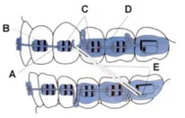 braces illustration