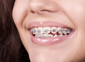 Smiling face with braces