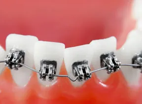close up of braces on teeth