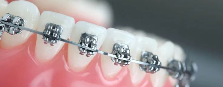 Close up of braces